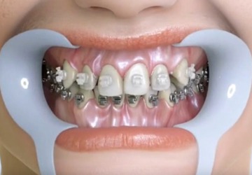 正畸后牙齿会倒向拔牙位置吗？